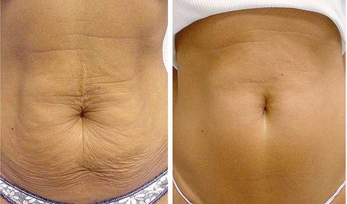 Side-by-side comparison of a person's abdomen showing loose skin in the 'before' image and a tightened appearance in the 'after' image.