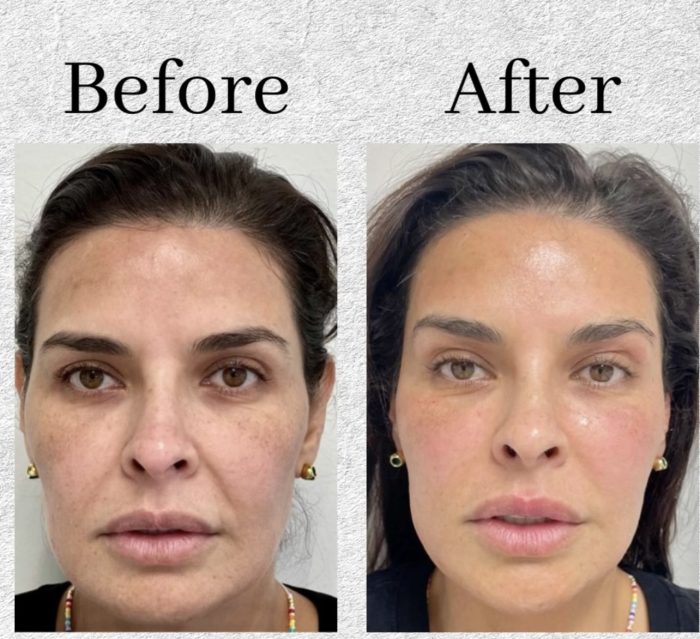 Laser Skin Tightening: What to Expect, Procedure, Results, Etc.