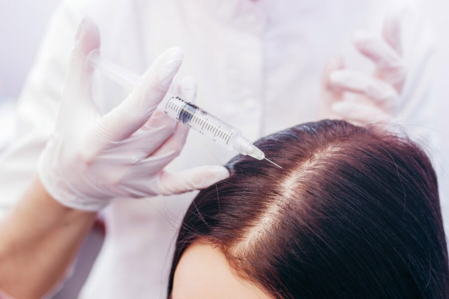 Close-up of a medical professional administering a hair restoration treatment with a syringe on the scalp of a patient wearing protective gloves.