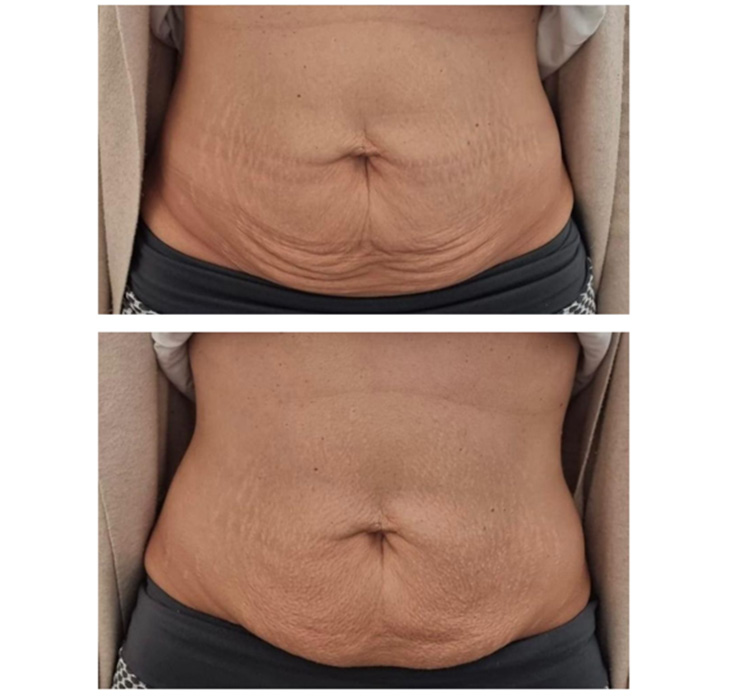 Before and after results showing skin tightening and toning on the abdomen area