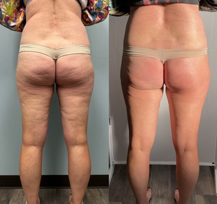 Before and after comparison of cellulite reduction and skin smoothing on a woman's legs