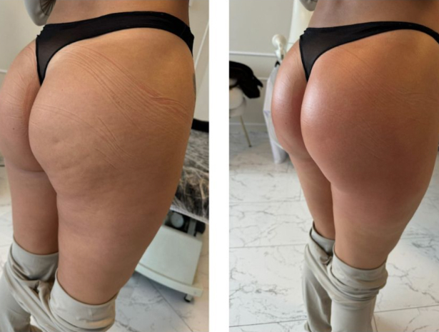 Before and after results showing reduced cellulite and tighter skin after one CryoSlimming treatment.