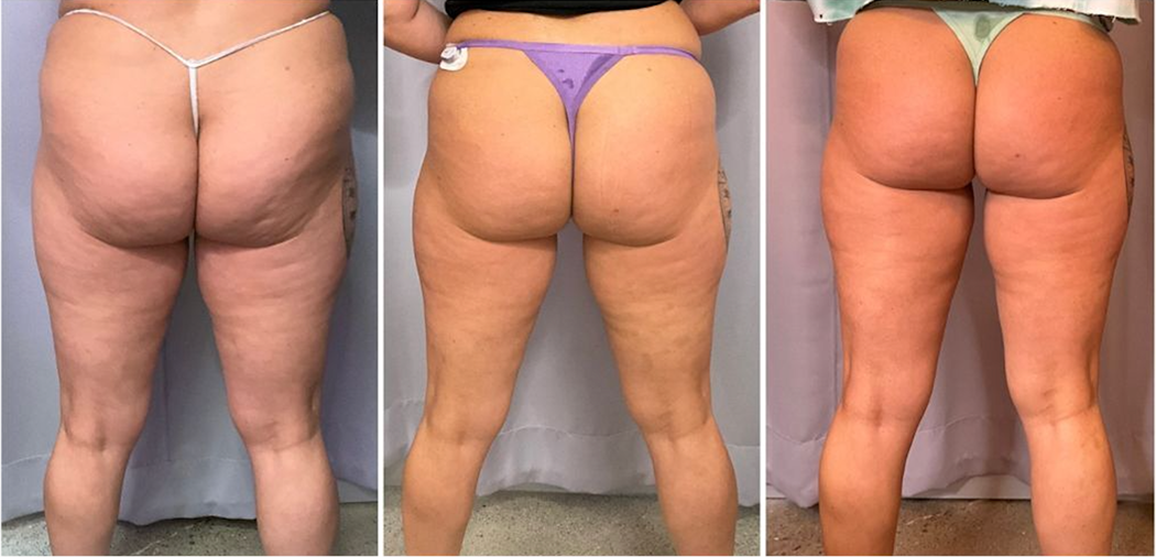 Back view transformation highlighting smoother and firmer skin after three CryoSlimming treatments.