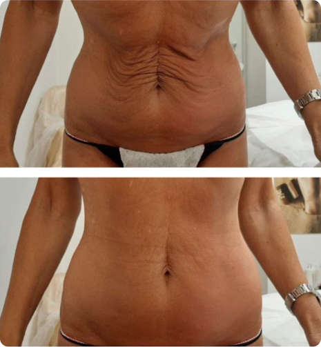 Visible improvement in skin tone and reduced fat appearance after three CryoSlimming sessions.