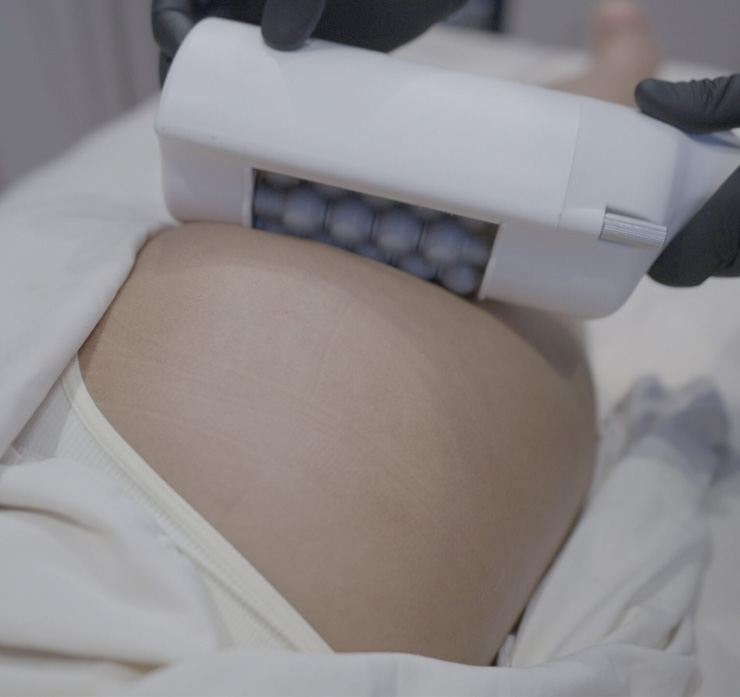 Close-up of T-Shape 2 device being used on a client's thigh during treatment