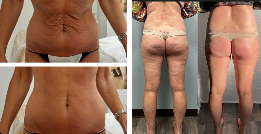 Before and after photos showing the effects of CryoSlimming treatments on stomach and thigh areas, with visible reduction in skin laxity and cellulite