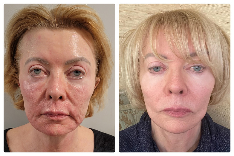 NexGen Before After