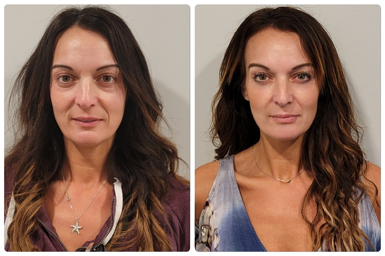 NexGen Before After
